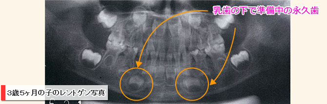 歯列育形成ではこれから生えてくる永久歯のことを考えながらアゴを育てていきます
