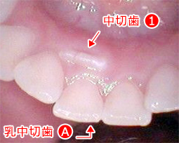 永久歯が乳歯の裏側から生えてきた