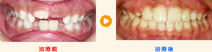 乳歯の裏側から生えてきた永久歯を歯列育形成で治療