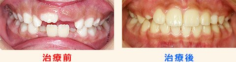 乳歯の裏側から生えてきた永久歯を歯列育形成で治療