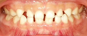 反対咬合を改善した乳歯列期の子どもの理想的な歯並び