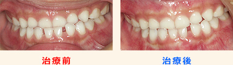 反対咬合を改善した乳歯列期の子どもの理想的な歯並び