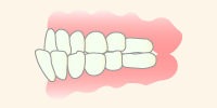 子どもの反対咬合