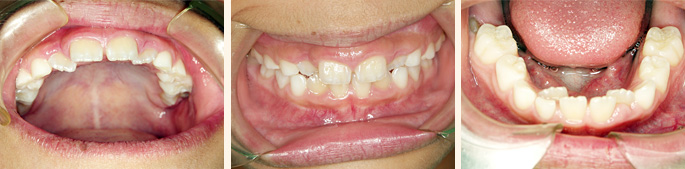 歯列育形成による矯正治療前