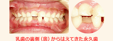 歯列育形成による矯正治療前。乳歯の裏側（奥）に見える永久歯