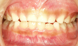 歯列育形成による矯正治療前。乳歯の裏側（奥）に見える永久歯