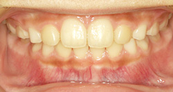 歯並びはキレイに育っています。歯並びを歯列育形成でさらに見守っていきます。