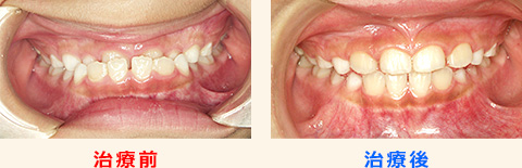 歯並び 矯正