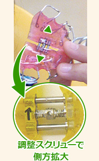 調整スクリューでプレートを側方拡大