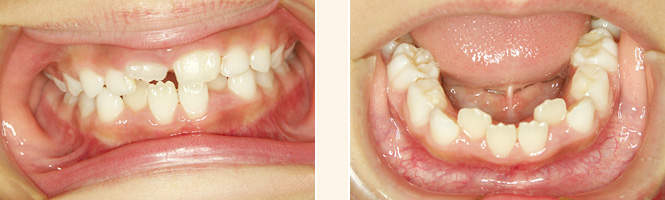 歯列育形成による矯正治療前