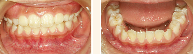 歯列育形成による継続管理中