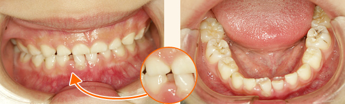 歯列育形成による矯正治療前