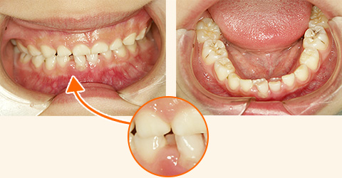 歯列育形成による矯正治療前