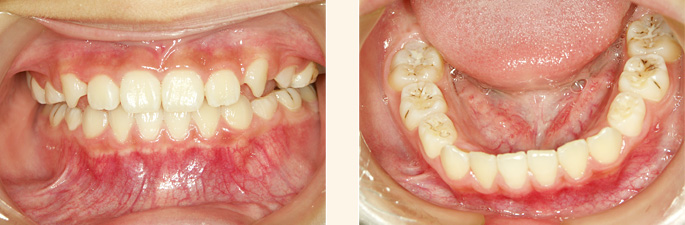 歯列育形成による 矯正中